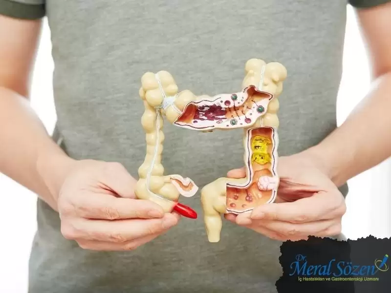 ulseratif-kolit-ve-crohn