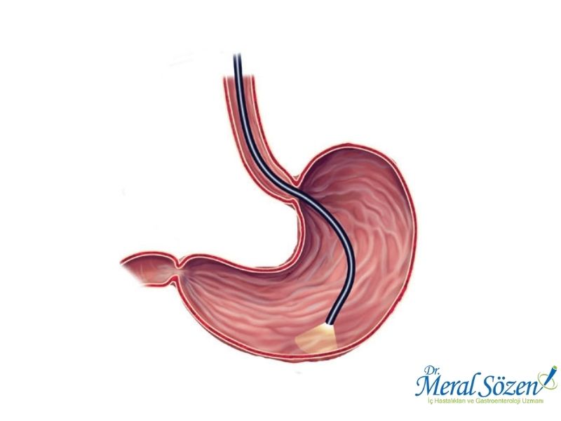 endoskopi-kimlere-yapilir