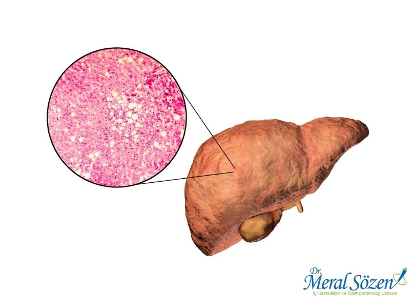 karaciger-yaglanmasi