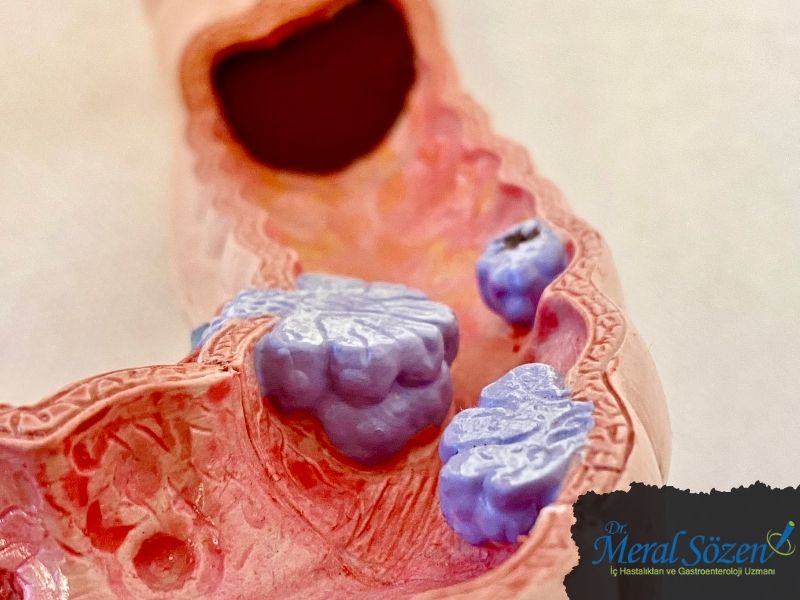 kolonoskopi-neden-yapilir