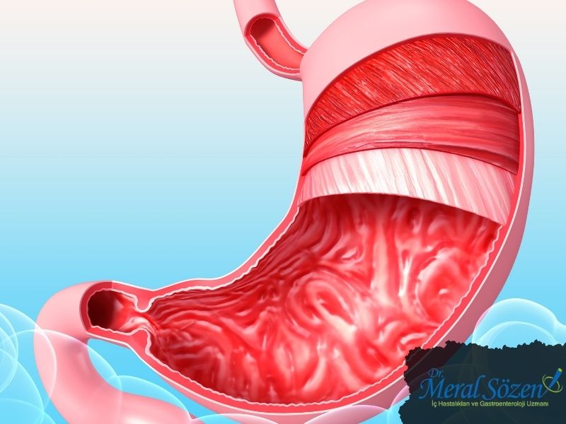 mide-ulseri-belirtileri-nelerdir