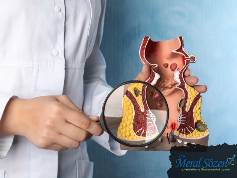 rektum-kanseri-neden-olur