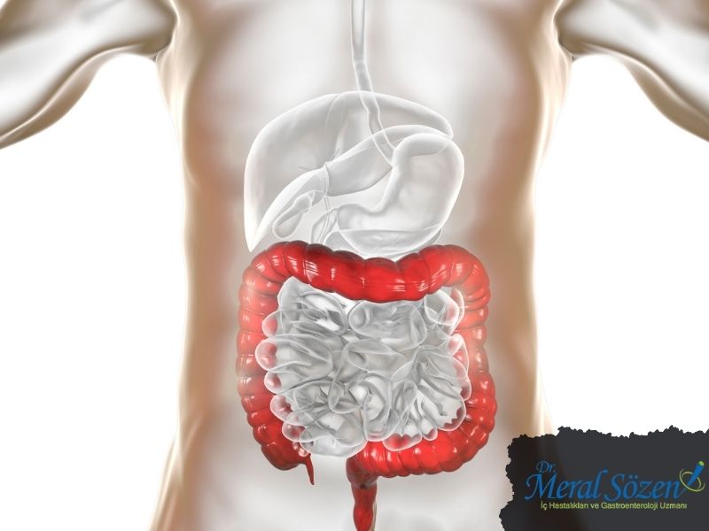 ulseratif-kolit-nedir