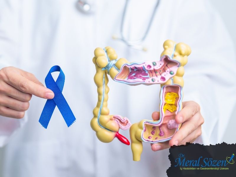 ulseratif-kolit-tipleri