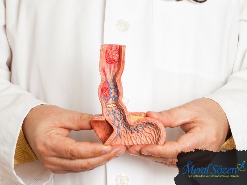 yemek-borusu-kanseri-tipleri-neler